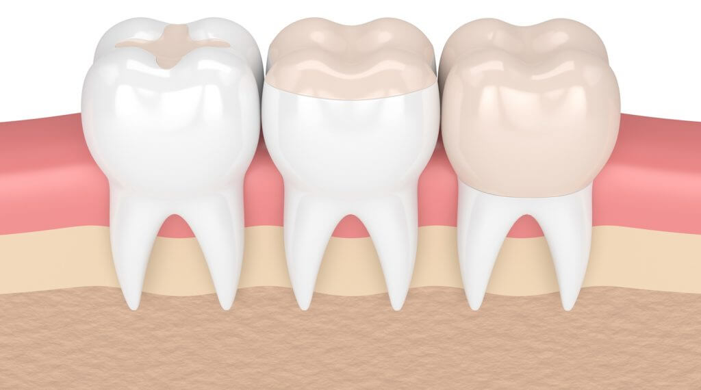 dental inlays